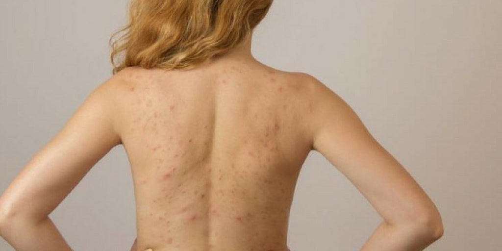 Backacne How To Get Rid Of It And How To Prevent It